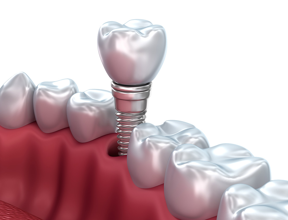 Oral İmplantoloji